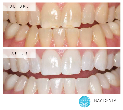 photo of teeth, before and after whitening